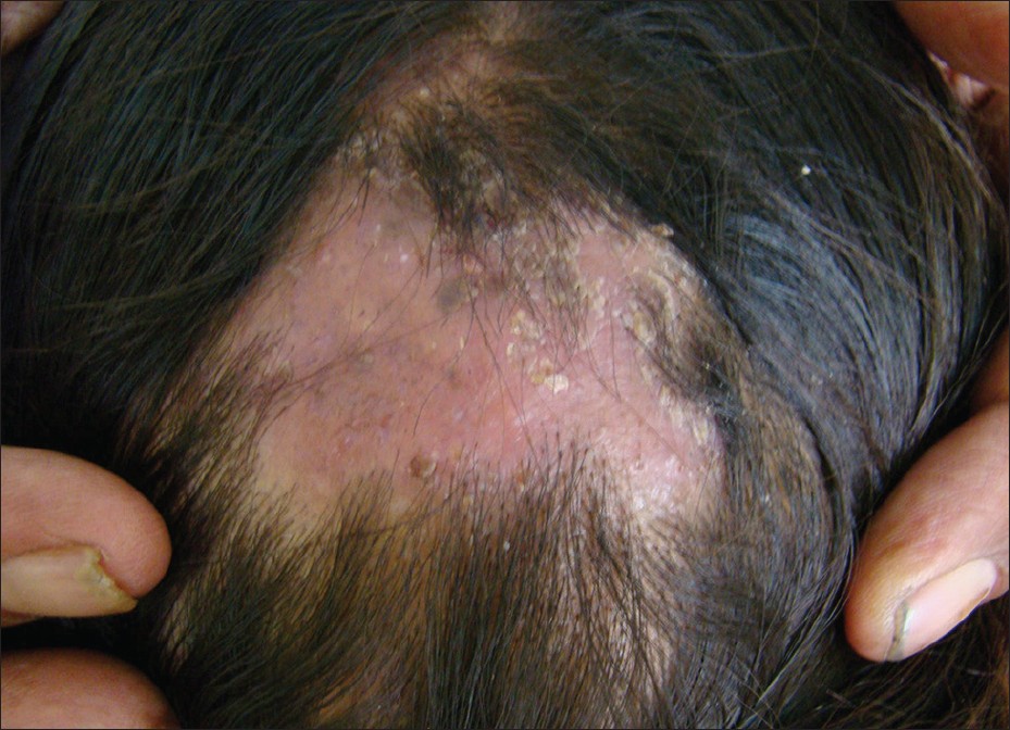 Mite infestation on human skin, symptoms, feeding ...